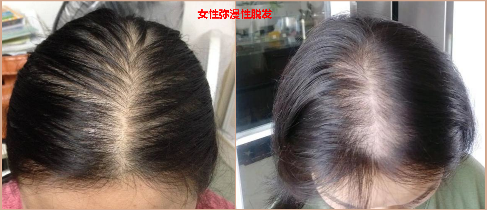 弥漫性脱发图